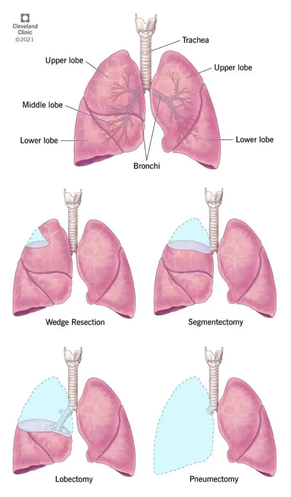 21868 lung resection