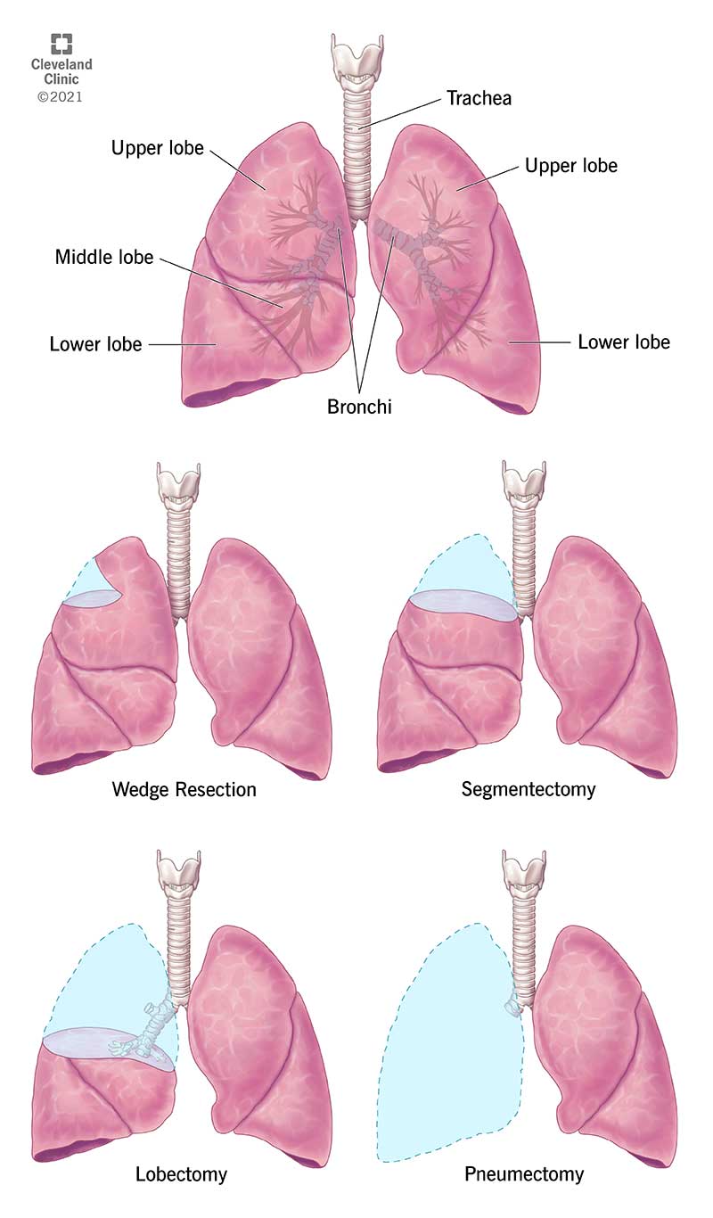 Kopsude diagramm ja illustreerivad näited erinevat tüüpi kopsude resektsiooni kohta.