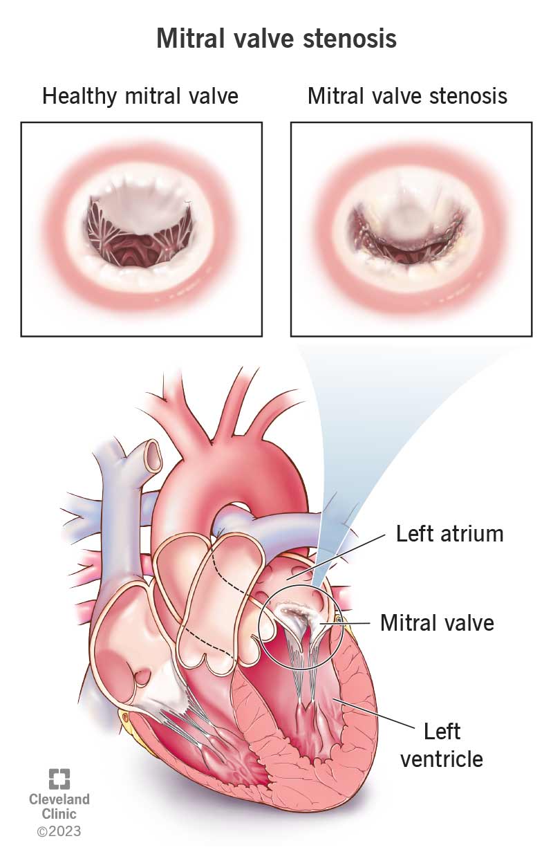 Mitraalklapi stenoos on kitsas avaus vere voolamiseks teie südame vasakpoolsete kambrite vahel.