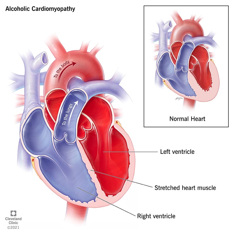 21994 alcoholic cardiomyopathy illustration