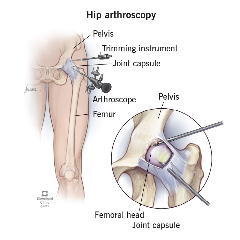 22195 hip arthroscopy