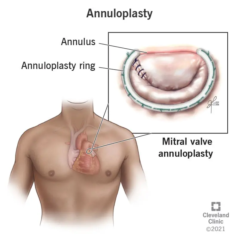 22224 annuloplasty