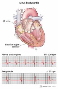 22473 sinus bradycardia