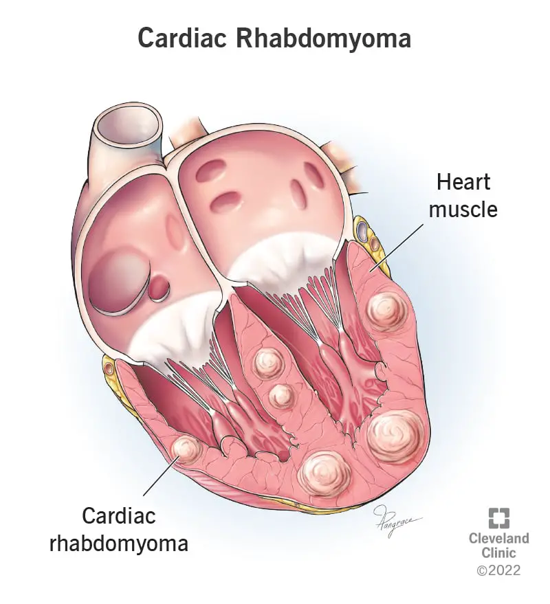 22499 cardiac rhabdomyoma