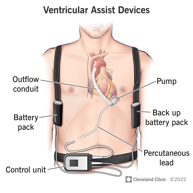 22600 ventricular assist devices
