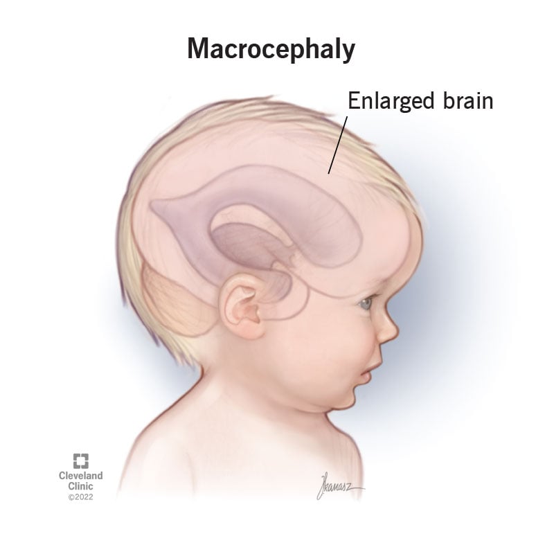 22685 macrocephaly