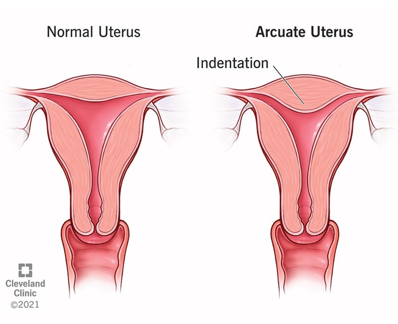 22811 arcuate uterus