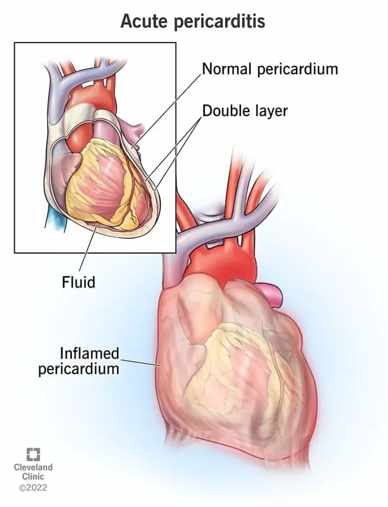 22918 acute pericarditis