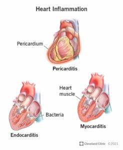 23052 heart inflammation