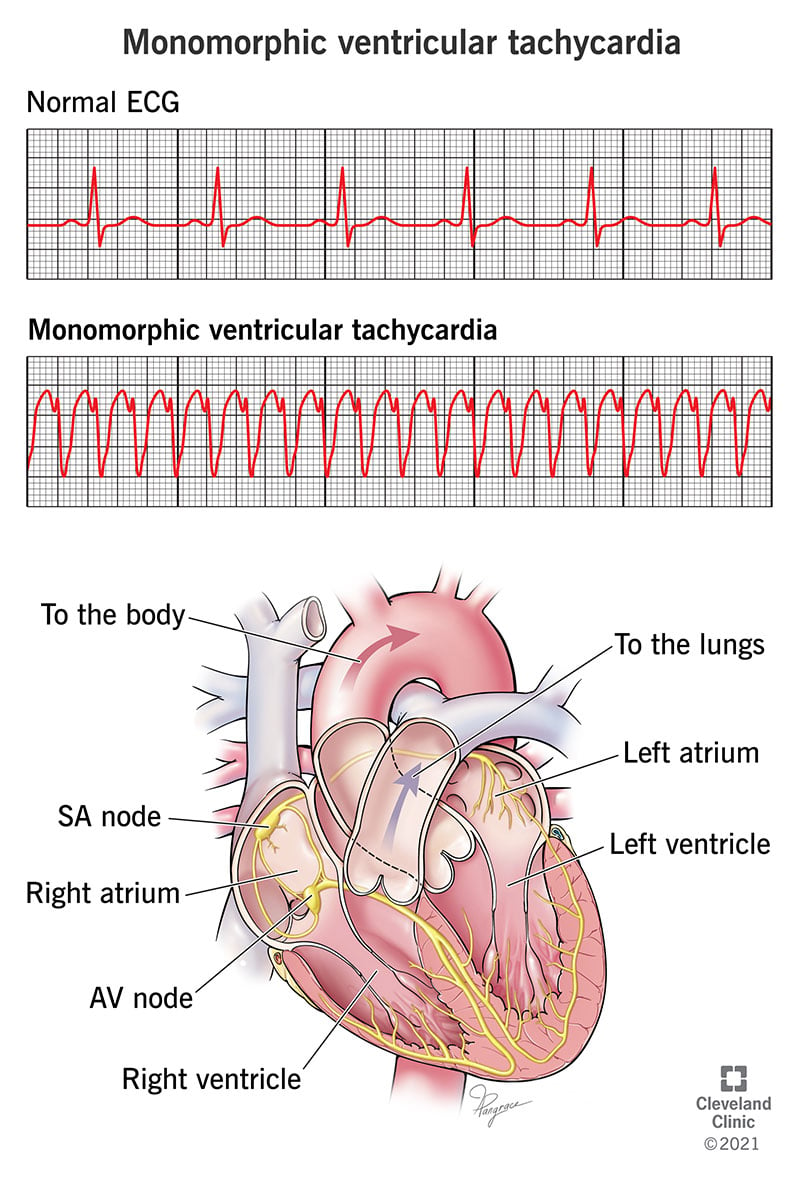 EKG, mis näitab monomorfset ventrikulaarset tahhükardiat.