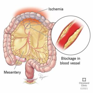 23246 mesenteric ischemia