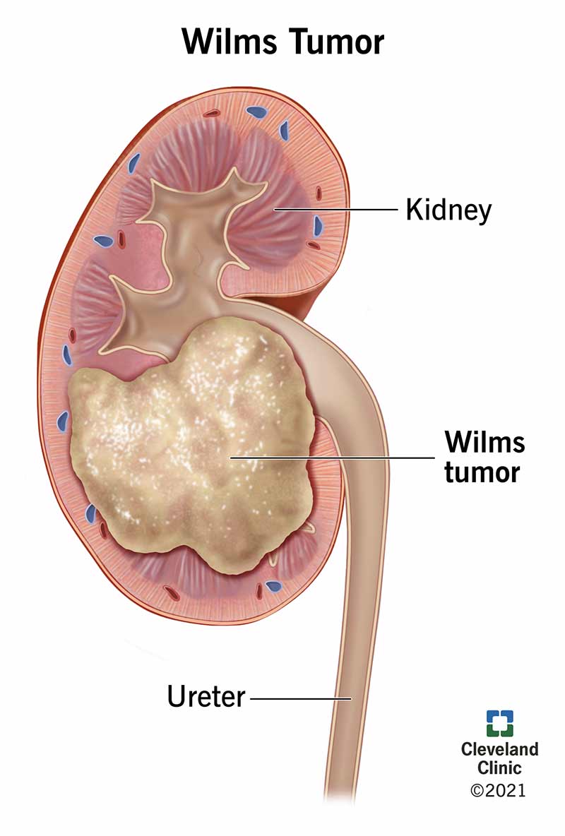 Wilmsi kasvaja kasvab neerus kusejuha lähedal.