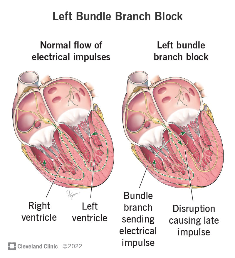 23287 left bundle branch block