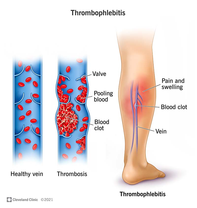 23311 thrombophlebitis