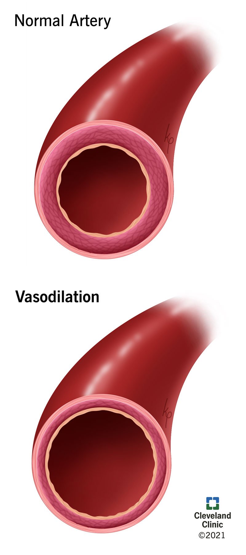Vasodilatatsioon põhjustab kahjustatud veresoone laienemist, mis võimaldab rohkem verd läbi voolata.