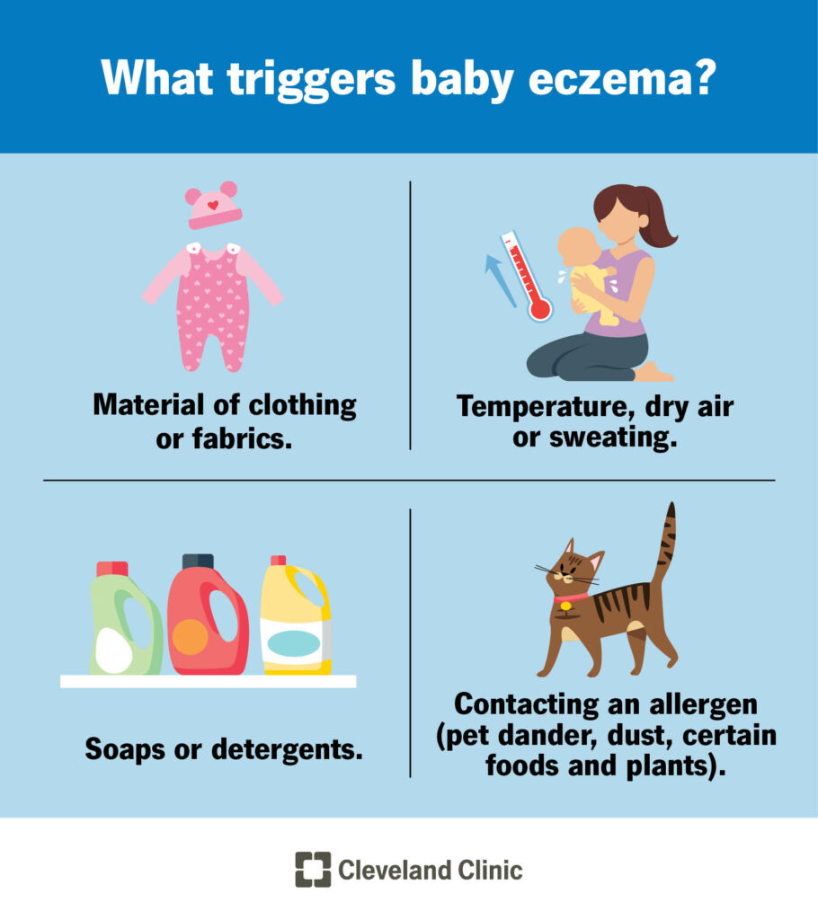 23408 baby eczema