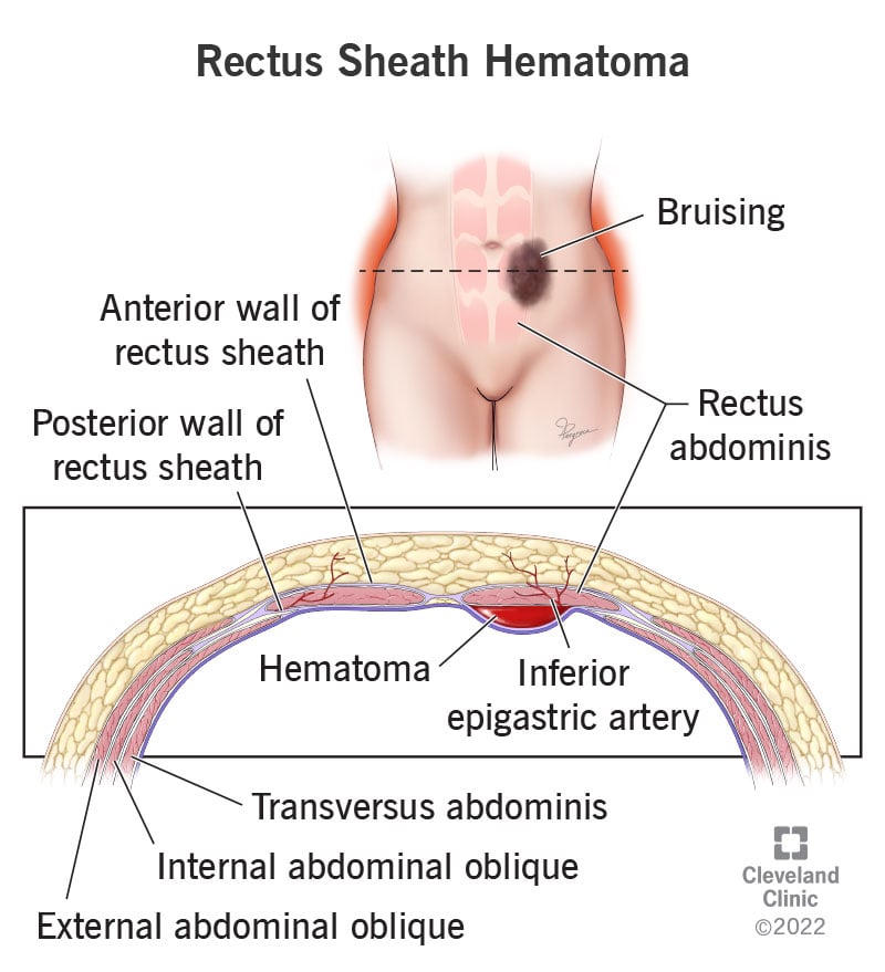 23934 rectus sheath hematoma