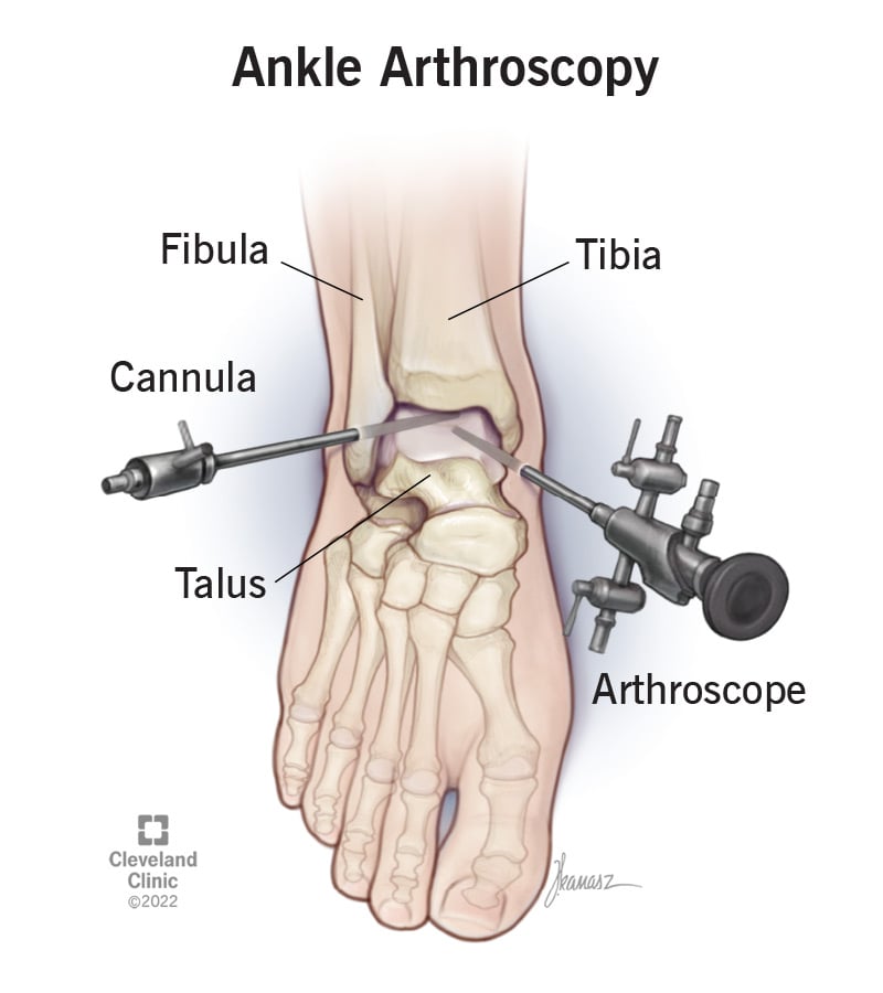 23977 ankle arthroscopy