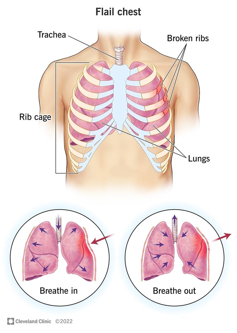 Illustratsioon, mis näitab, kuidas murdunud ribid segavad hingamist inimesel, kelle rindkere on loksunud.