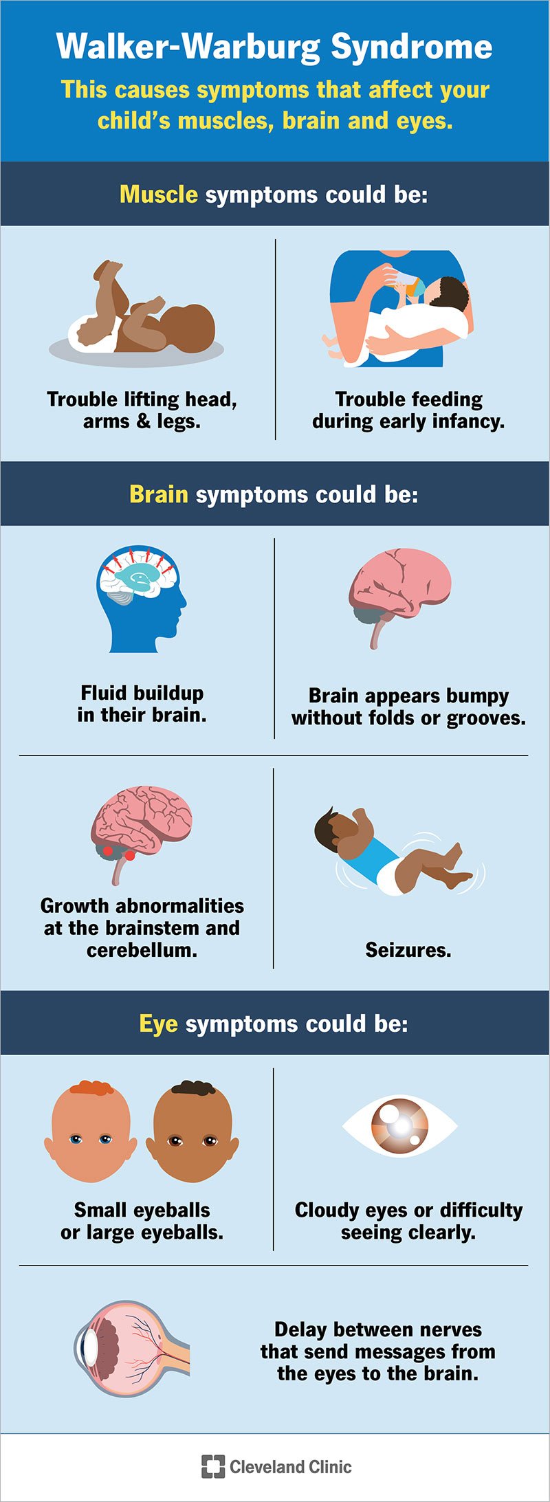 Loetelu Walker-Warburgi sündroomi sümptomitest, mis mõjutavad lapse lihaseid, aju ja silmi.
