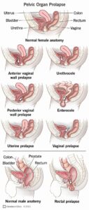 24046 pelvic organ prolapse