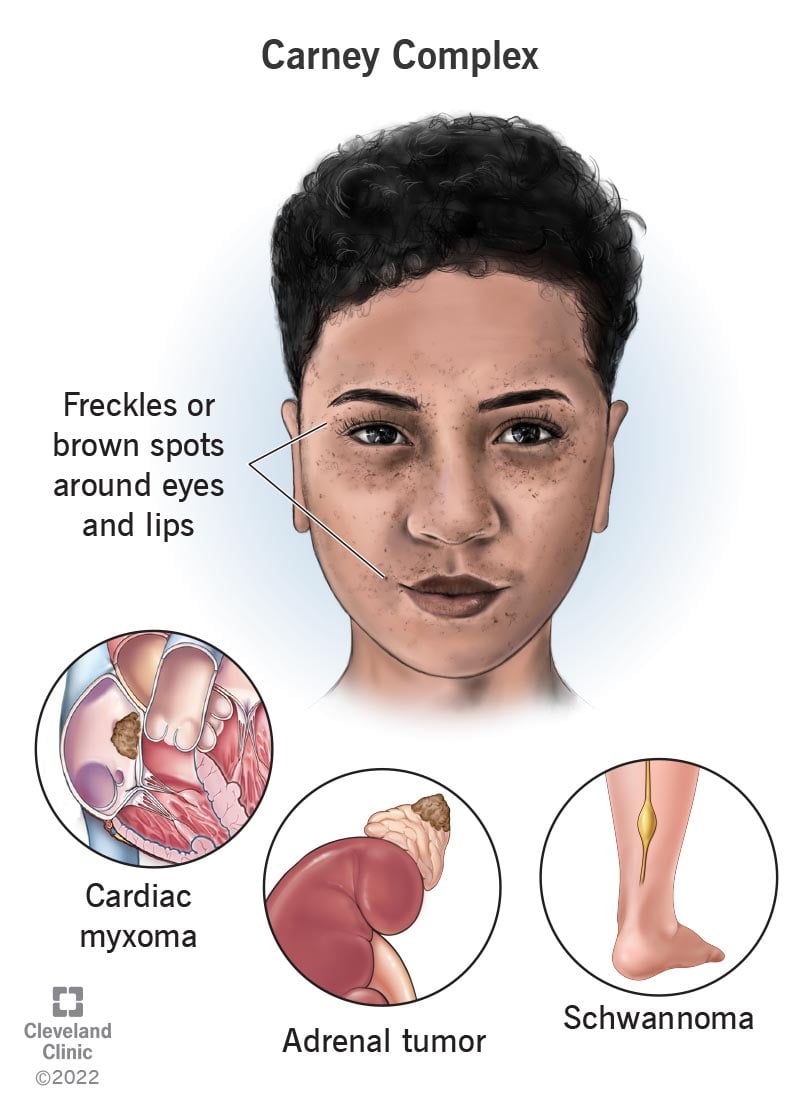 Noor inimene, kellel on Carney kompleks, haruldane pärilik haigus, mis põhjustab muutusi nahavärvis ja kasvajaid.