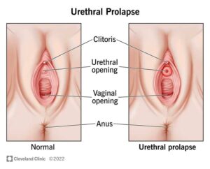 24177 urethral prolapse