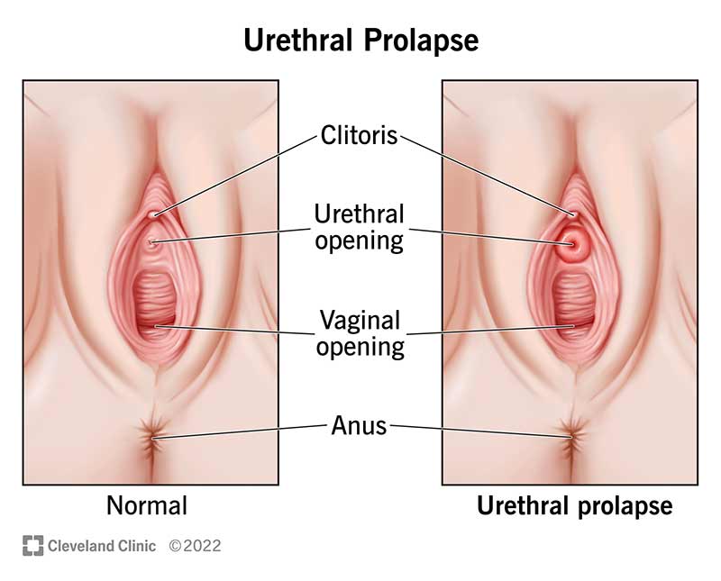 Normaalne ureetra vs ureetra prolaps.