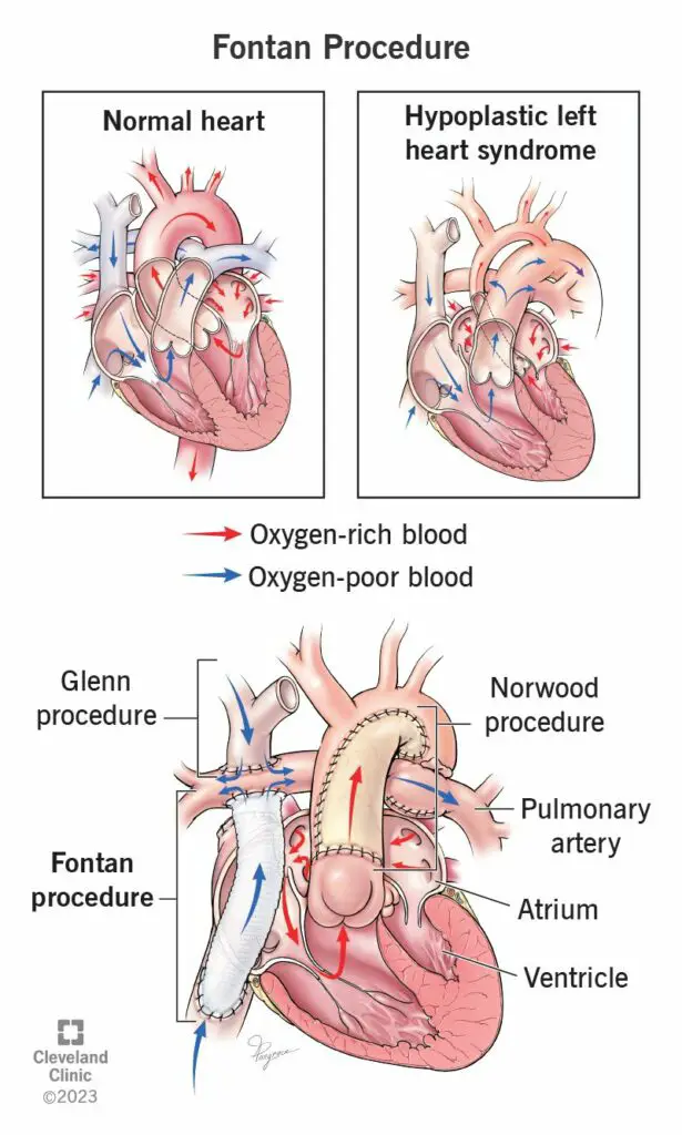 24545 fontan procedure