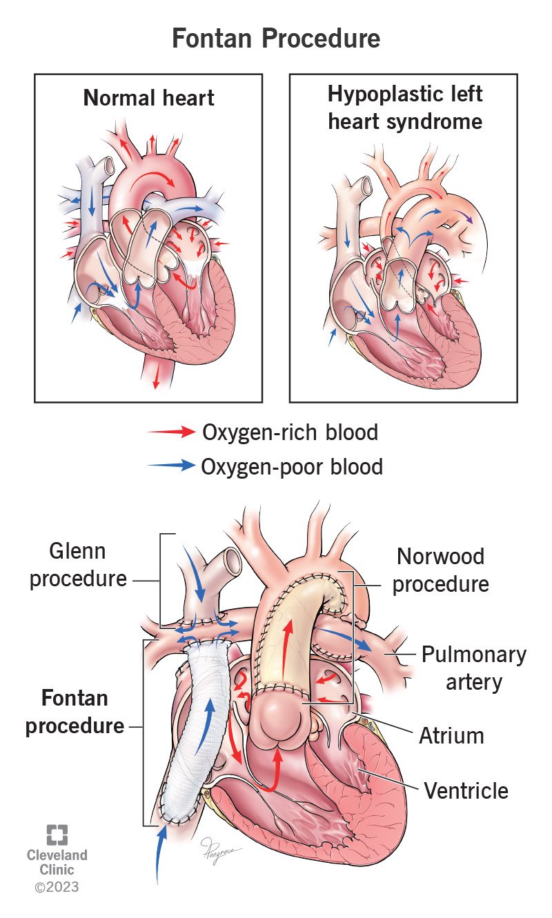 Fontani protseduur võimaldab hapnikuvaesel verel alakehast minna südamest mööda minnes kopsuarterisse.