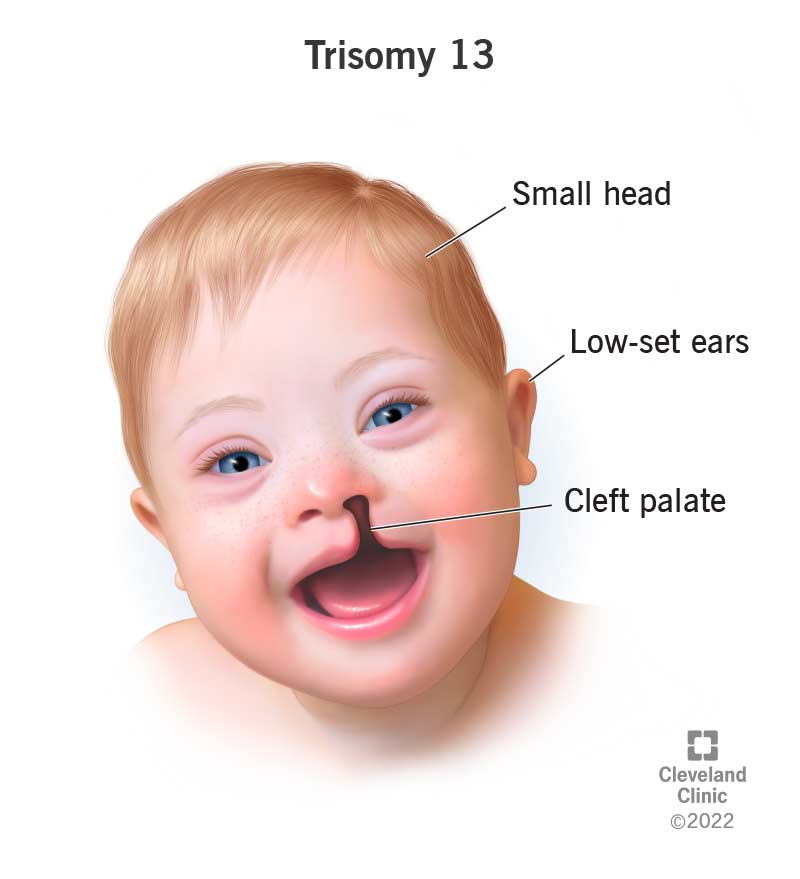 24647 trisomy 13 patau syndrome