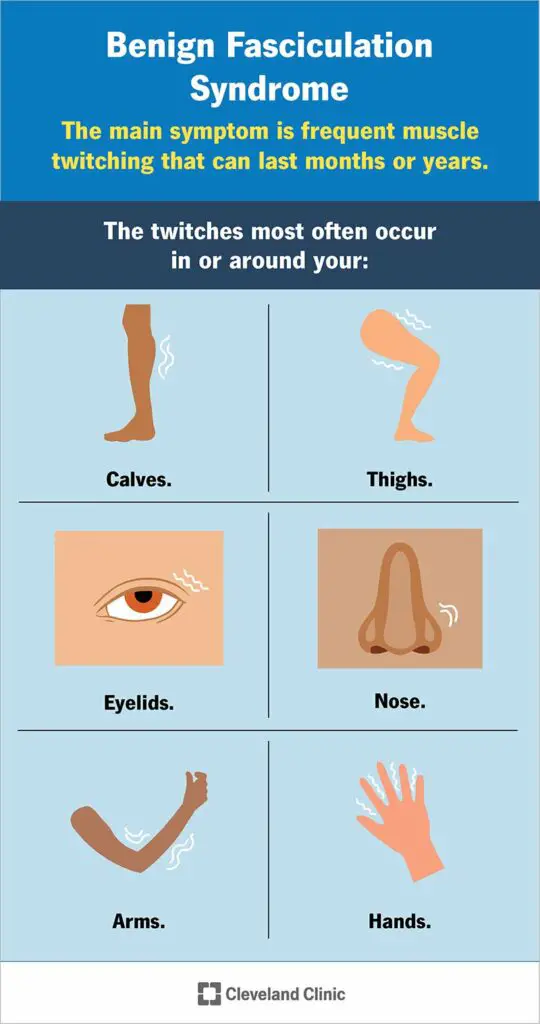 24812 benign fasciculation syndrome