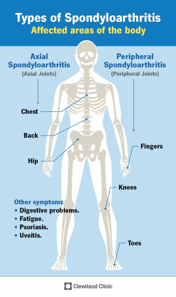 24843 axial spondyloarthritis infographic
