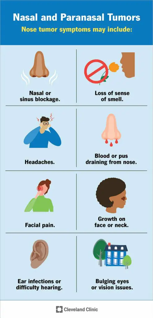 24927 nasal paranasal tumors