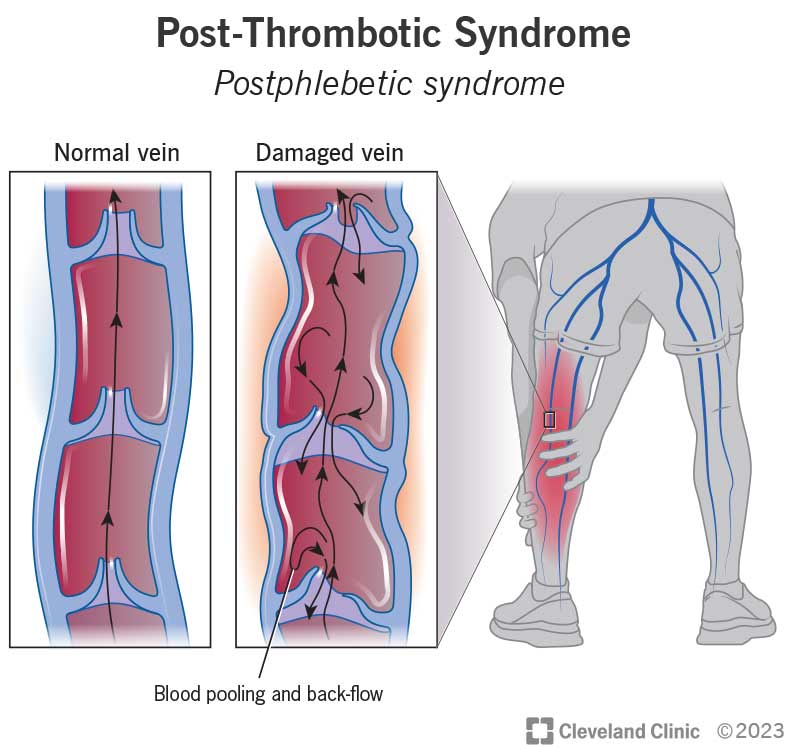 24936 post thrombotic syndrome