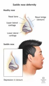 24978 saddle nose