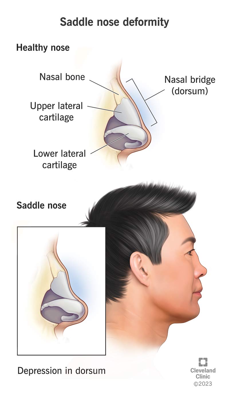Sadulanina deformatsioon vs terve nina, mis näitab depressiooni seljaosas (ninasild).