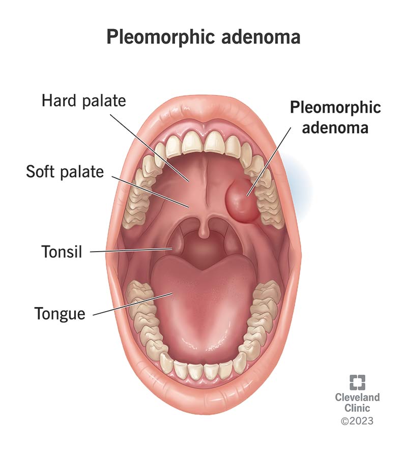 Pleomorfne adenoom (paremal) on healoomuline (mittevähiline) kasvaja, mis võib areneda teie süljenäärmetes.