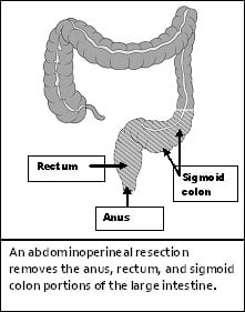 abdominoperineaalne resektsioon