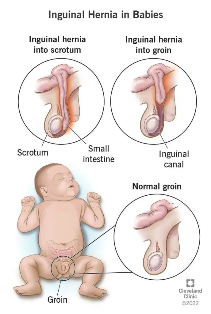 4337 inguinal hernia in babies