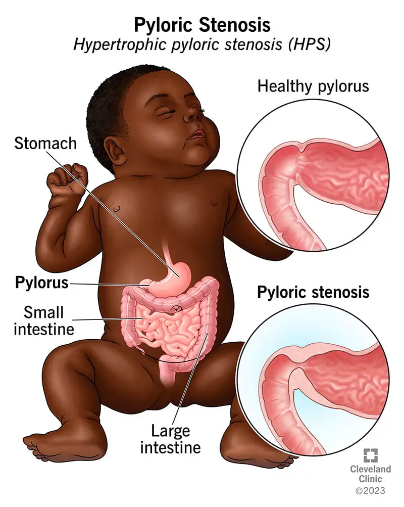 4524 pyloric stenosis