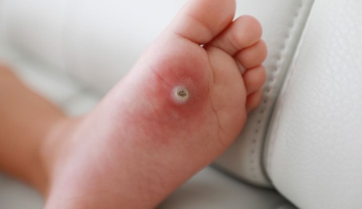 Laste tüükad on teatud tüüpi nahainfektsioon, mida põhjustab HPV.  Nakkus põhjustab teie lapse nahale kõvade punnide moodustumist.