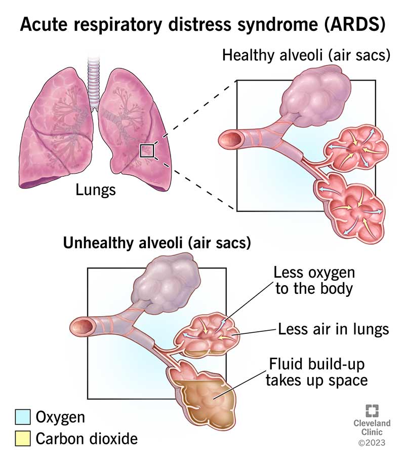 acute respiratory stress syndrome
