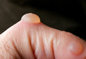 closeup Blister Hand 170617489 770x553 1