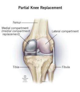 partial knee replacement