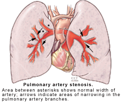 pulmonary artery stenosis