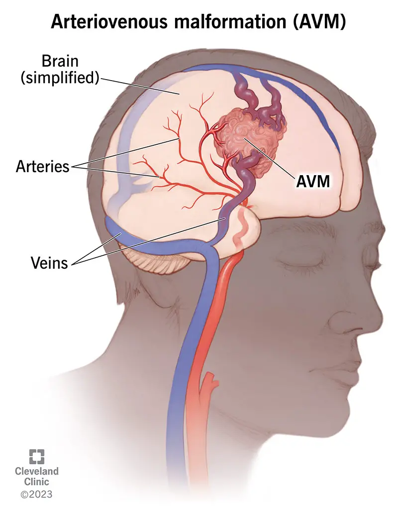 Arteriovenoosne väärareng näeb välja nagu mitu veresooni, mis on omavahel sassis.