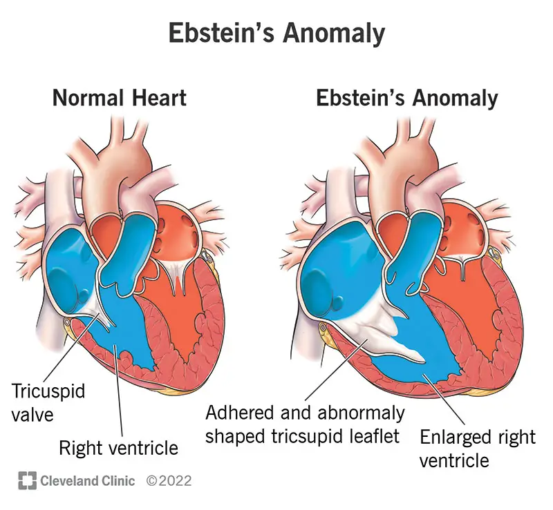 Ebsteini anomaaliate võrdlus