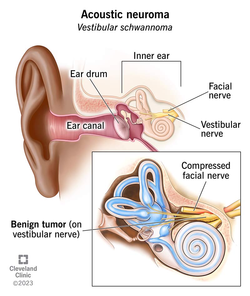 1705030101 16400 acoustic neuroma