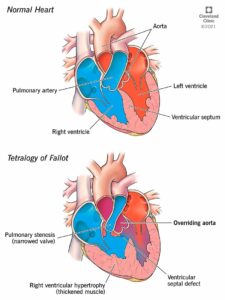 1705076545 23347 overriding aorta